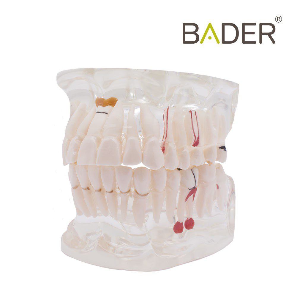 MODELO DENTAL TRANSPARENTE IMPLANTE