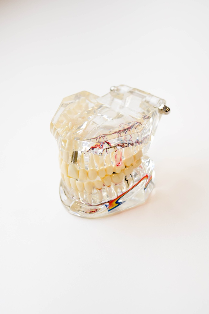 MODELO DENTAL DE IMPLANTE CON NERVIO